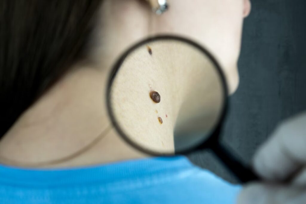 What to Expect During a Skin Check Skin Check